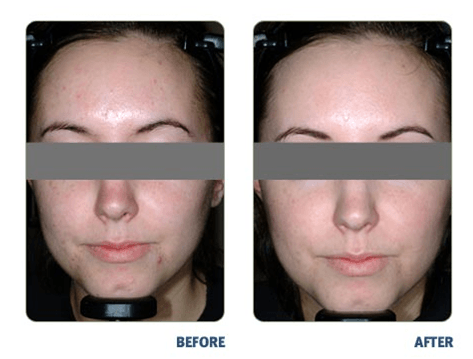 blue light facial for acne