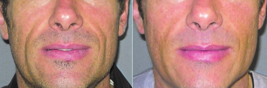 bellafill aesthetic man mouth before afterjpg