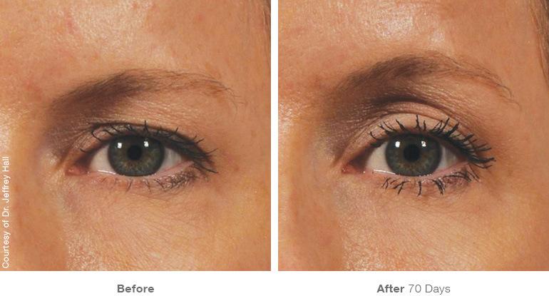 ultherapy before and after