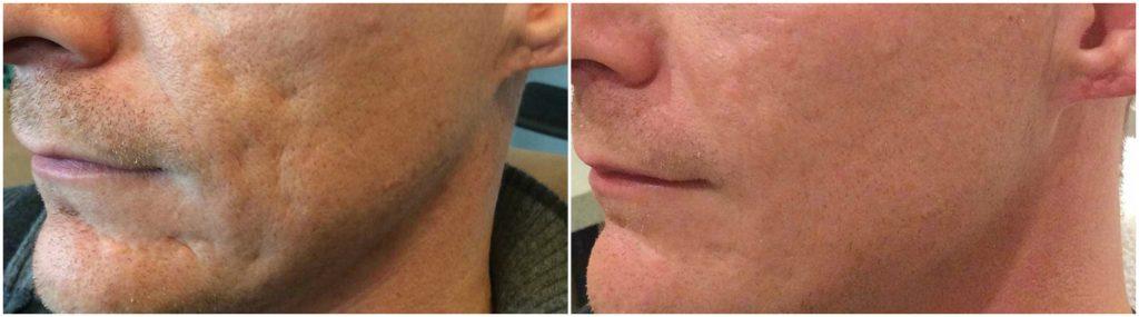 EverYoung Bellafill acne scars before and after Vancouver BC Dr. Zheng