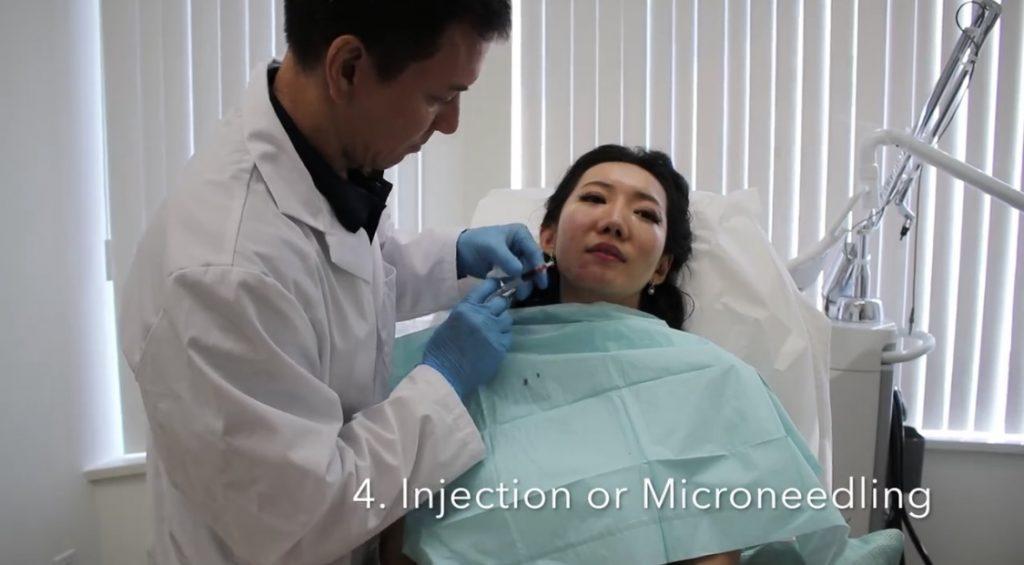 injection microneedling eym vancouver