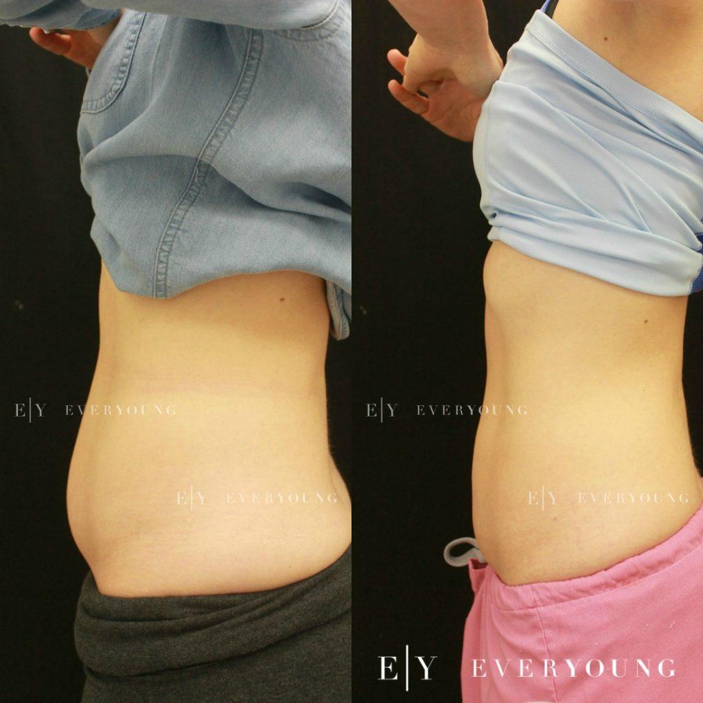 Sculpting a Smaller Waist with CoolSculpting Before & After Photos