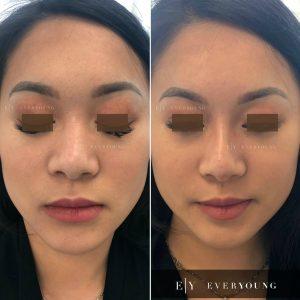 Everyoung vancouver Non surgical nose job instagram