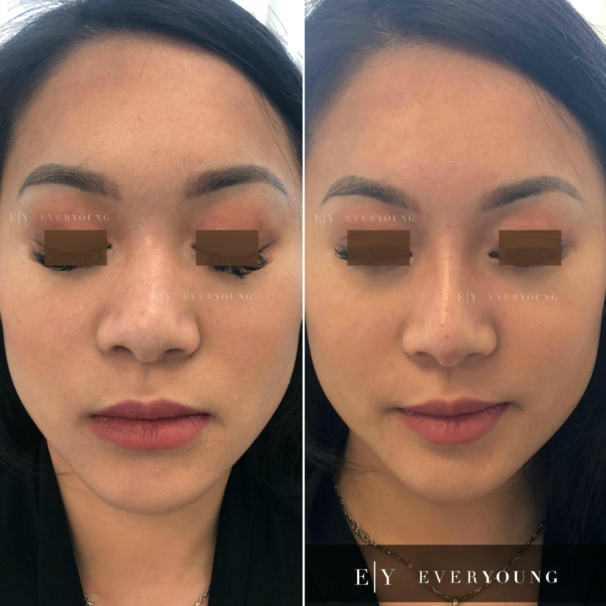 how to get rid of cheek lines by nose