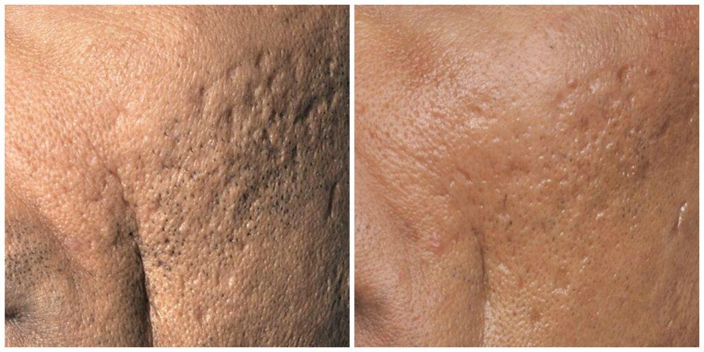 Laser Brown Spot Removal Acnescarsbeforeandafter Laser Skin Resurfacing Laser Skin Rejuvenation Skin Resurfacing