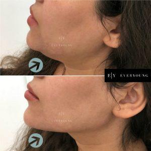 Beiamed - V LINE CONTOUR** This is a technique used in facial contouring to  narrow the lower part of the face for a more natural, softer jaw line. This  procedure addresses all