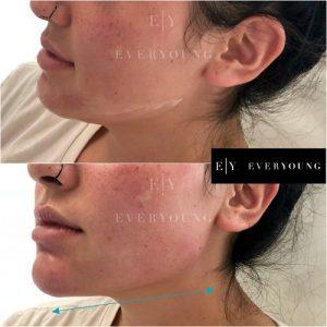 Face Shaping & Facial Contouring Treatments Vancouver