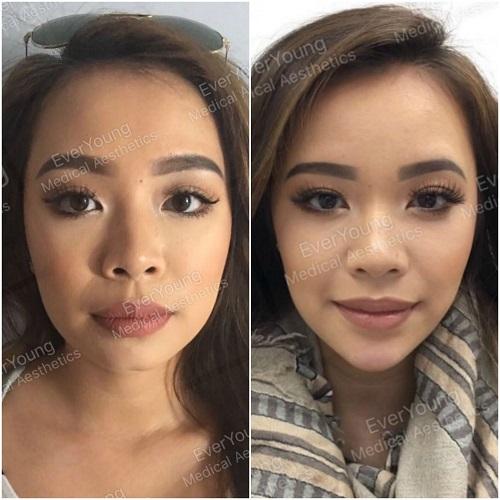 Face Shaping & Facial Contouring Treatments Vancouver