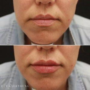 EverYoung medspa lip augmentation lip injections fuller lips cosmetic doctor port coquitlam