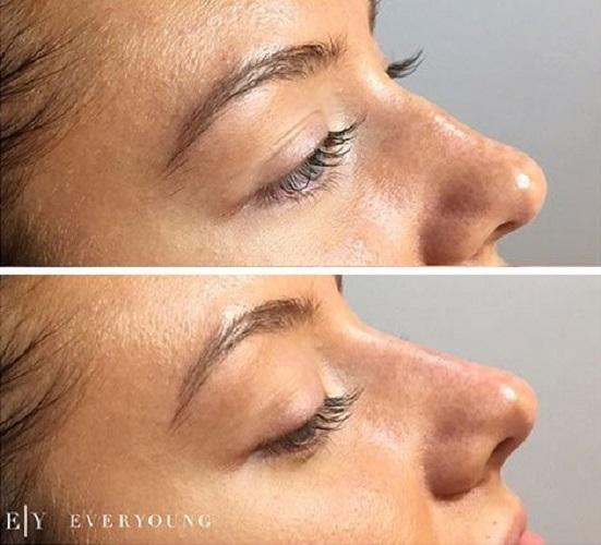 Non-Surgical Facial Contouring - Essential Aesthetics