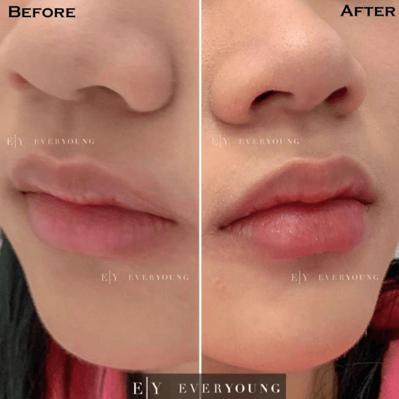 dermal fillers before and after