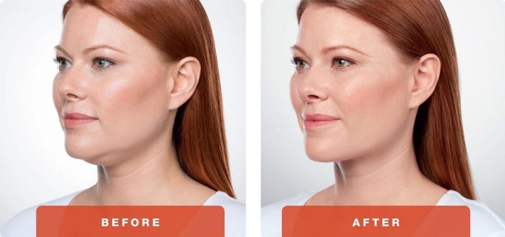 Body Contouring Near Me  Remove Chin Fat, Double Chin — Lazaderm