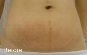 1-velashape-before-after-EverYoung-Medical-Aesthetics-cellulite-fat-loss-Vancouver-Port-Coquitlam