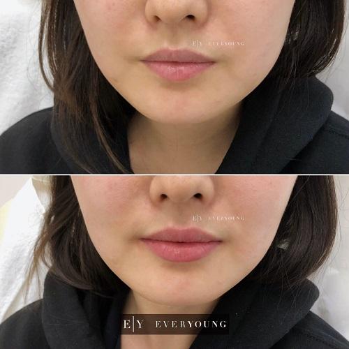 lip augmentation