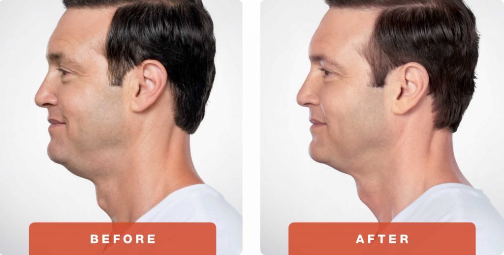 2-Kybella-Belkyra-double-chin-treatment-underchin-fat-medsap-Port-Coquitlam-Burnaby-EverYoung-Medical-Aesthetics-1