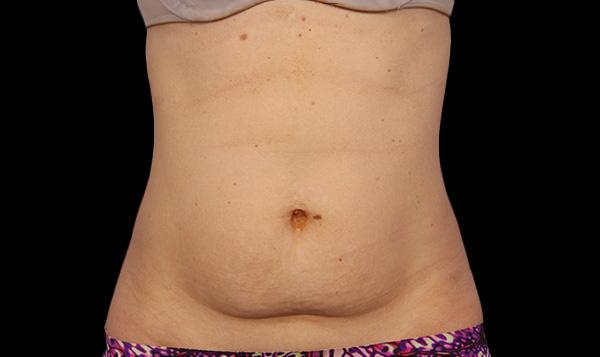 Coolsculpting West Vancouver  Fat Freezing Treatments at EverYoungMed