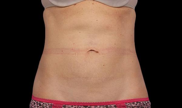 CoolSculpting Port Moody BC  Body Contouring Port Moody BC