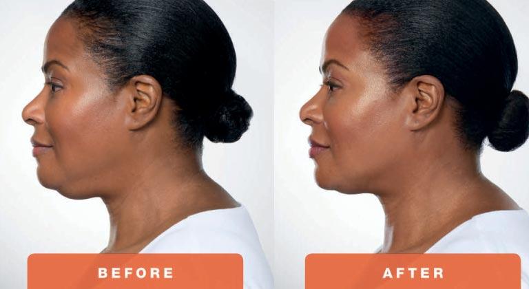 3-Kybella-Belkyra-double-chin-treatment-underchin-fat-medsap-Port-Coquitlam-Burnaby-EverYoung-Medical-Aesthetics-1