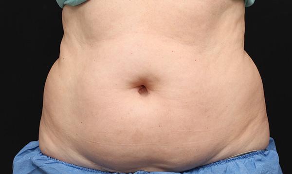 Where does the fat go during CoolSculpting? - Sheer Sculpt