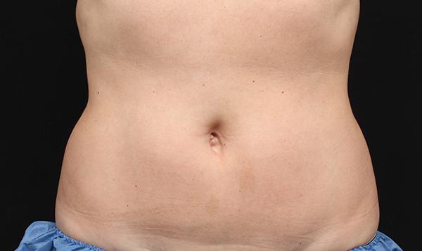 SheerSculpt - The Top CoolSculpting Clinic Serving the Tri State Area