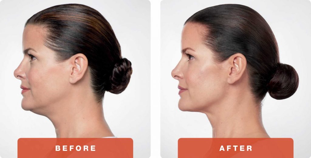 4-Kybella-Belkyra-double-chin-treatment-underchin-fat-medsap-Port-Coquitlam-Burnaby-EverYoung-Medical-Aesthetics-1