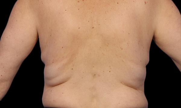 Coolsculpting North Vancouver  Fat Freezing Treatments at