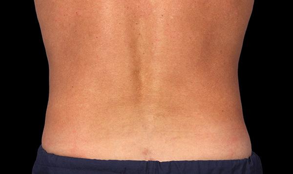 Coolsculpting Vancouver  Fat Freezing Treatments at EverYoungMed