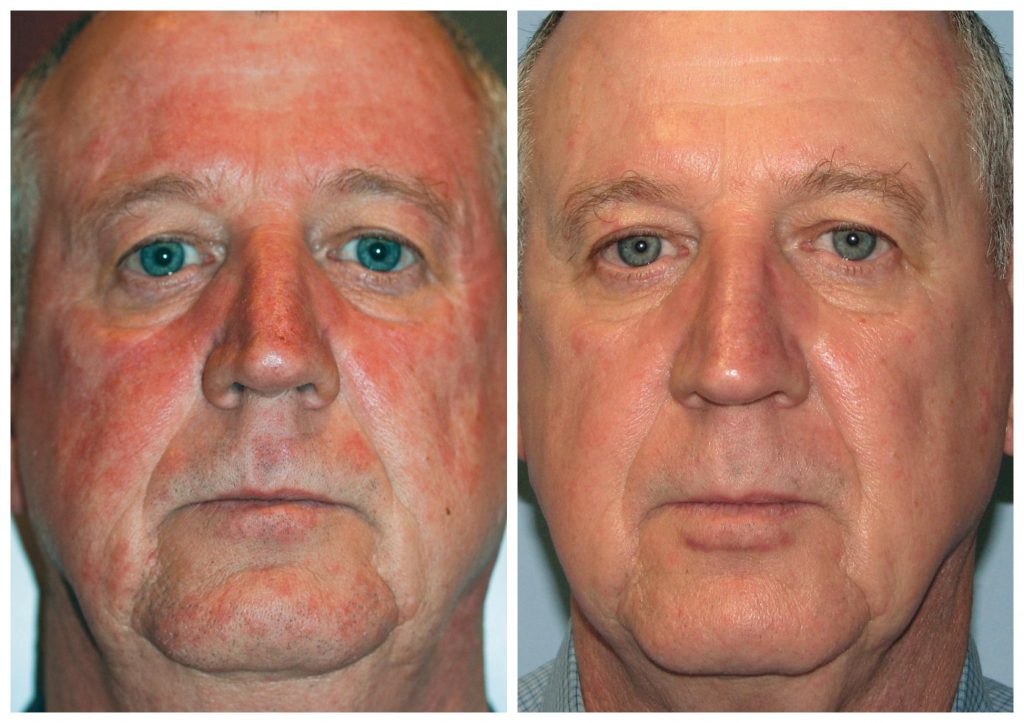 Rosacea Redness Vein Brown Spot Treatment Vancouver | EverYoung Skin Care Clinic