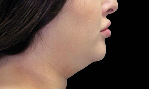 Fat Freezer Chin & Neck Sculpting System