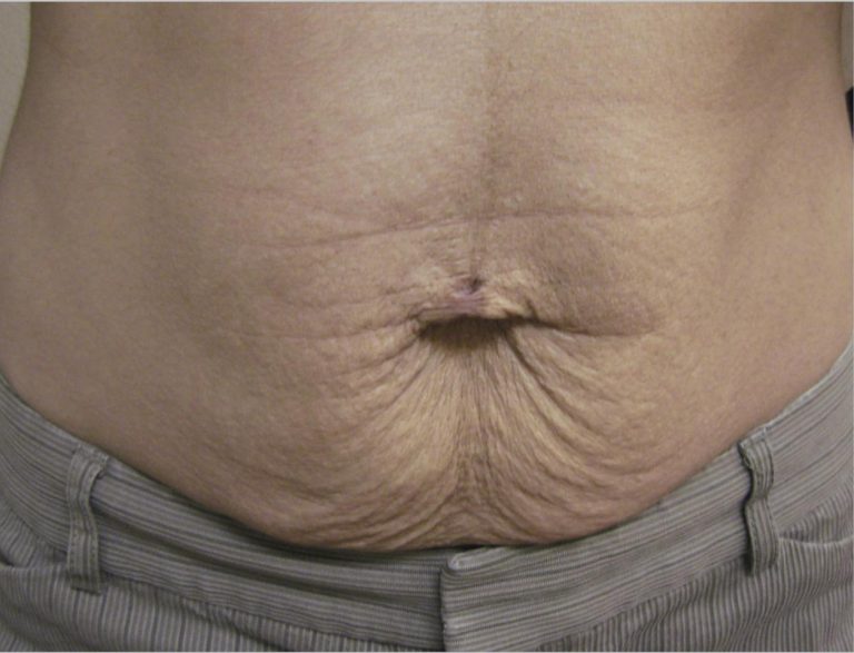 Laser Skin Tightening for Stomach Near Me