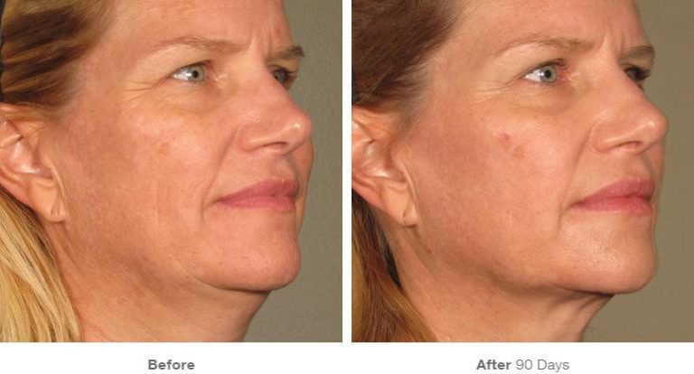 Ultherapy Skin Tightening and Toning in Port Coquitlam and Burnaby BC