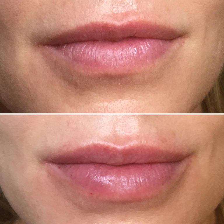 Lip Fillers Vancouver Lip Injections at Everyoung in Port