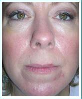 rosacea-after1