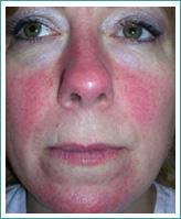 rosacea-before1