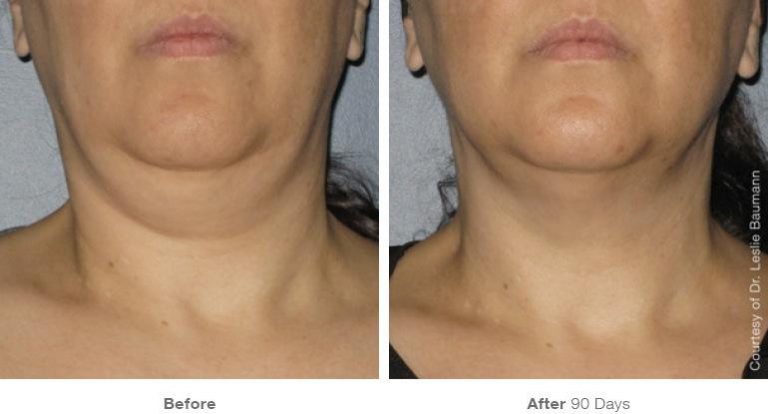 Ultherapy Skin Tightening and Toning in Port Coquitlam and Burnaby BC