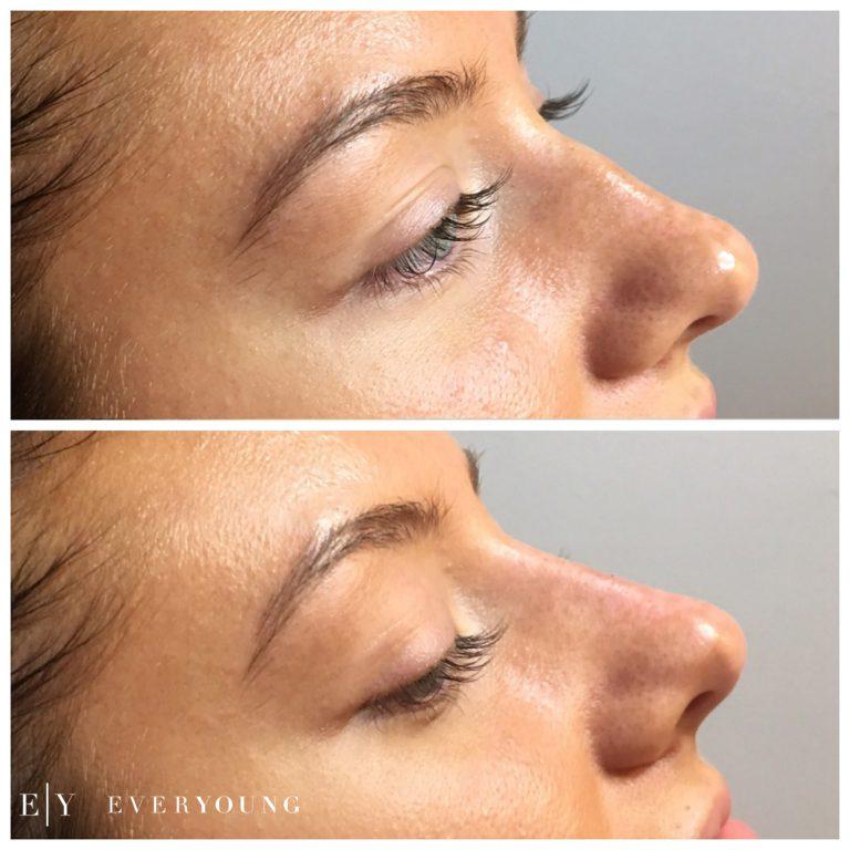 Non-surgical nose job (nose contouring) - CosMedics