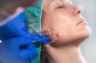 Thread Lift for Non-Surgical Facelifts