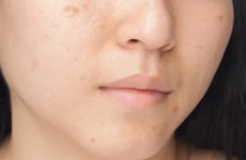 Long Lasting Fillers and Bellafill | EverYoung Skin Care Clinic