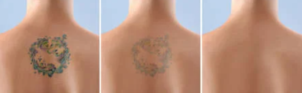Tattoo Removal Vancouver | EverYoung Skin Care Clinic