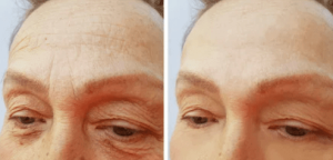 botox and dermal fillers-min