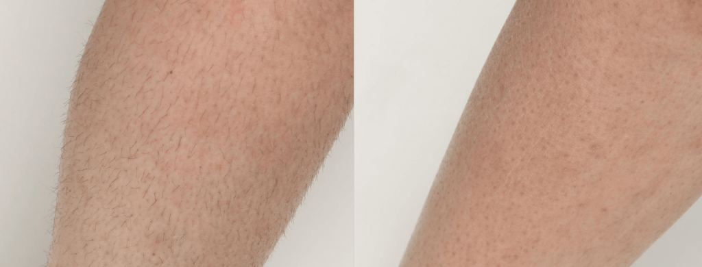 area of the body for laser hair removal
