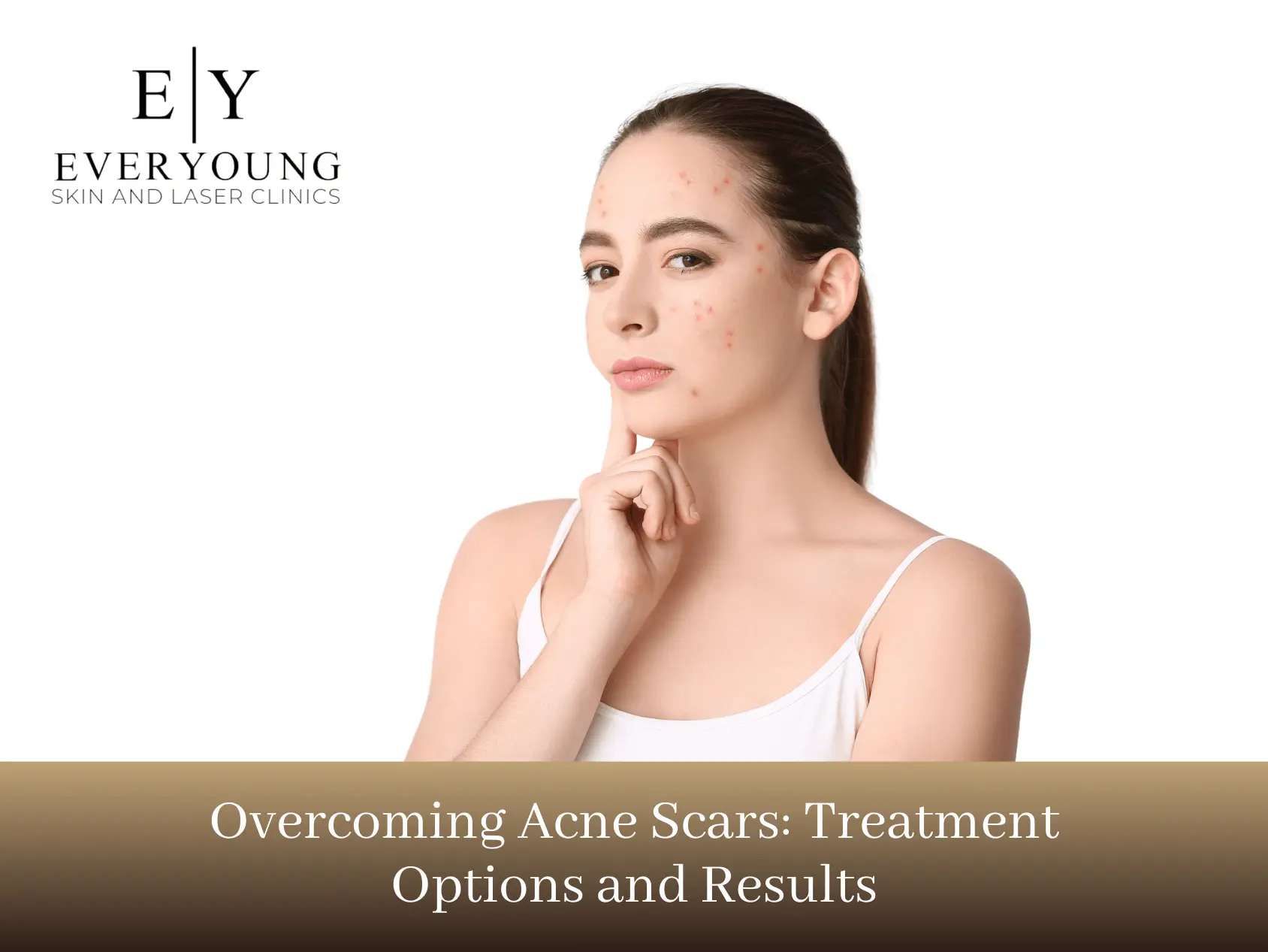 Overcoming acne scars treatment options and results