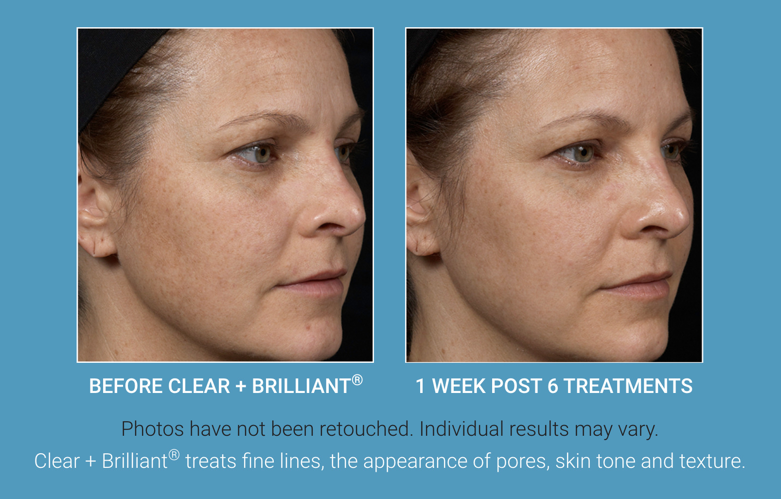 Clear + Brilliant Laser Skin Treatment Vancouver | EverYoung