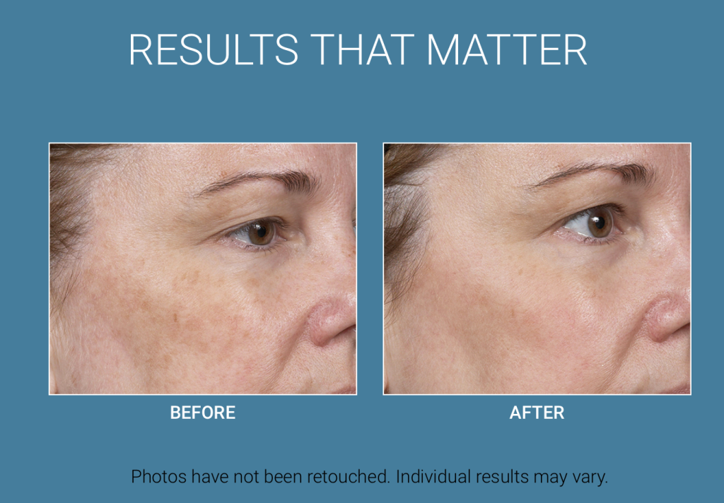 Before & After Results | EverYoung Skin Care Clinic