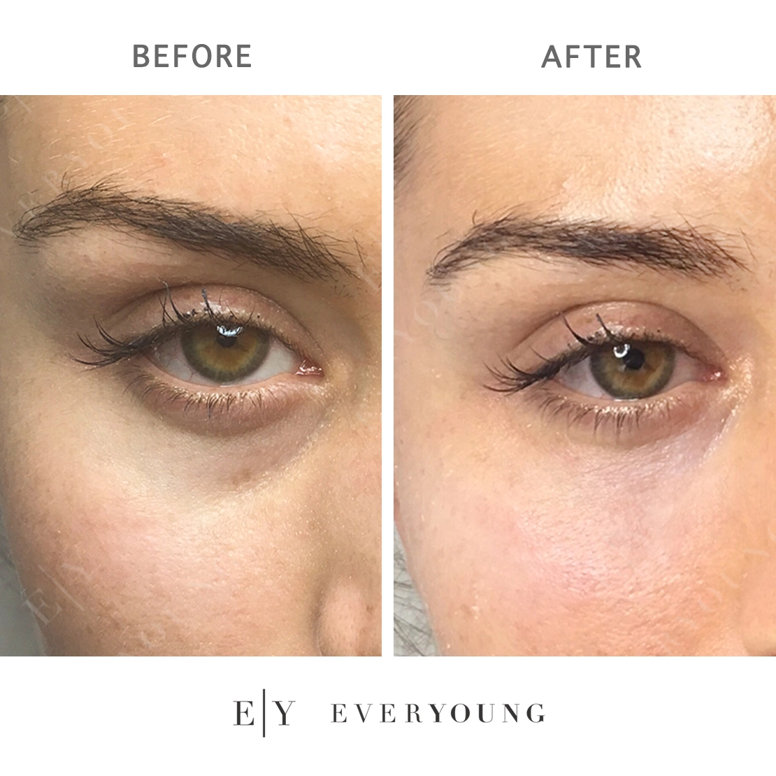 Before and After Results | EverYoung Skin Care Clinic Vancouver