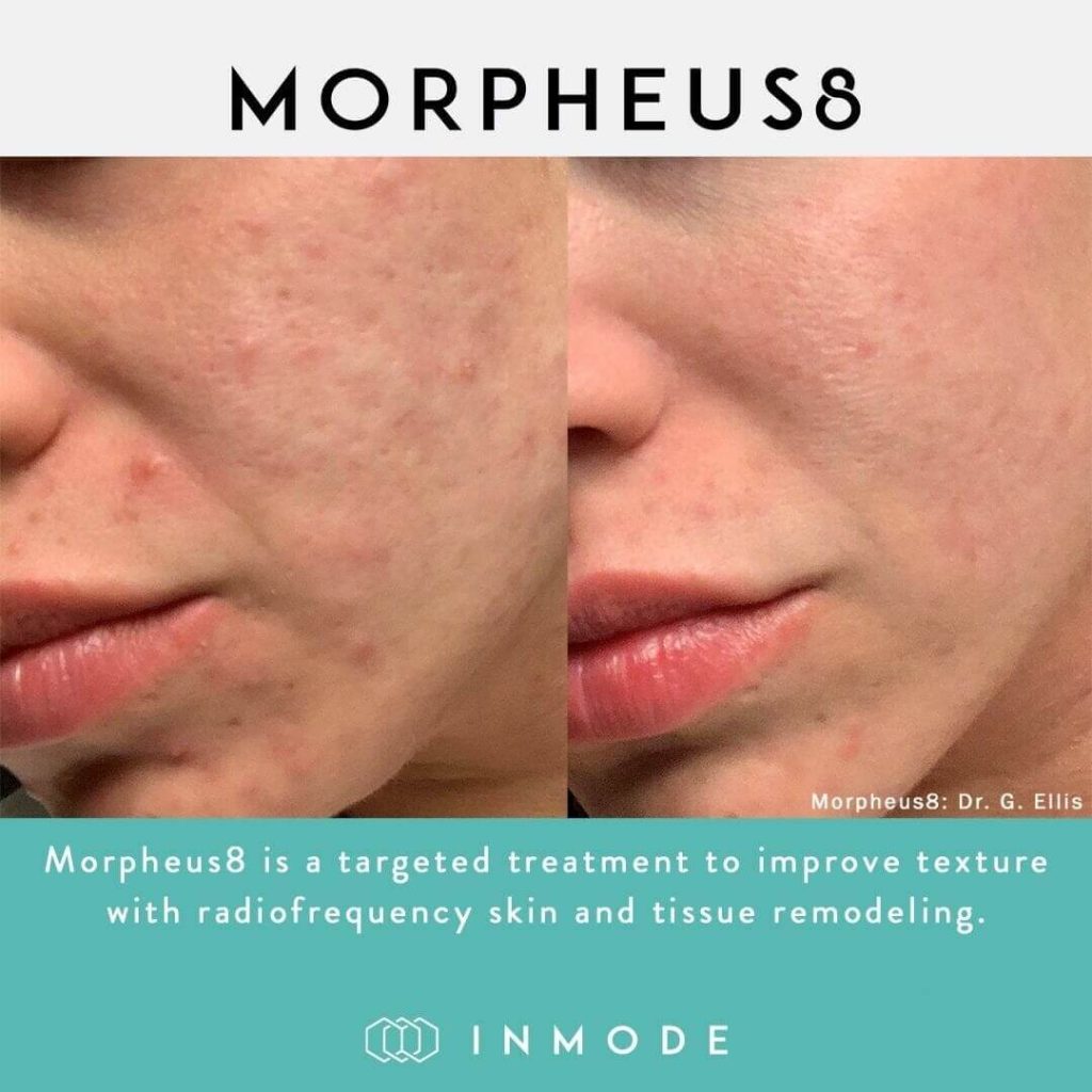 Morpheus8 Treatment for Acne​ | EverYoung Laser & Skin Clinic Vancouver