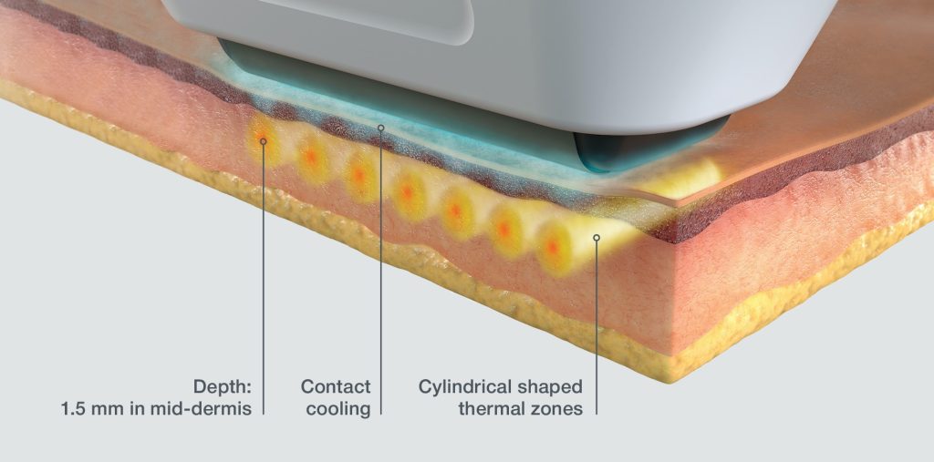 How Does Sofwave Treatment Work?​ | EverYoung Laser & Skin Clinic Vancouver