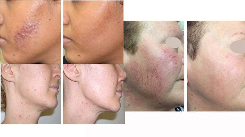 Harmony® XL Pro VL Dye Laser - Before & After | EverYoung Medical Aesthetics Laser and Skin Clinic​