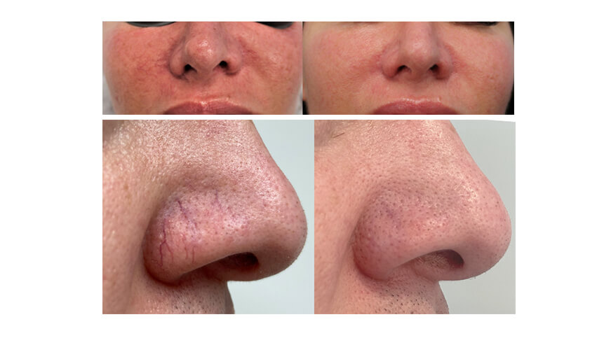 Harmony® XL Pro ClearLift Before & After Treatment Vancouver | EverYoung Medical Aesthetics Laser and Skin Clinic​