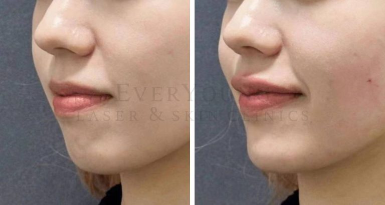 Chin Fillers - Before & After | EverYoung Laser & Skin Clinic